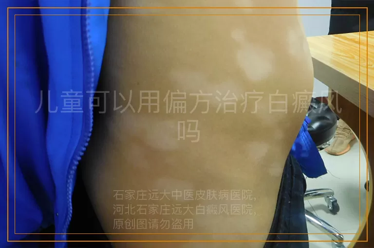 儿童可以用偏方治疗白癜风吗
