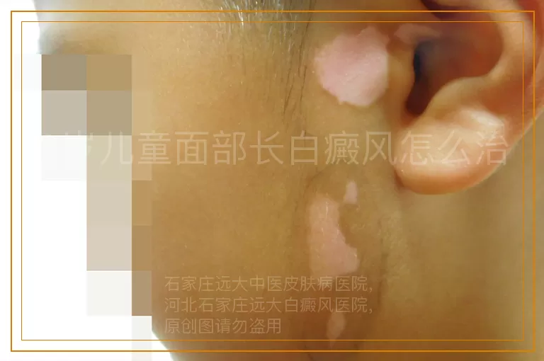 9岁儿童面部长白癜风怎么治
