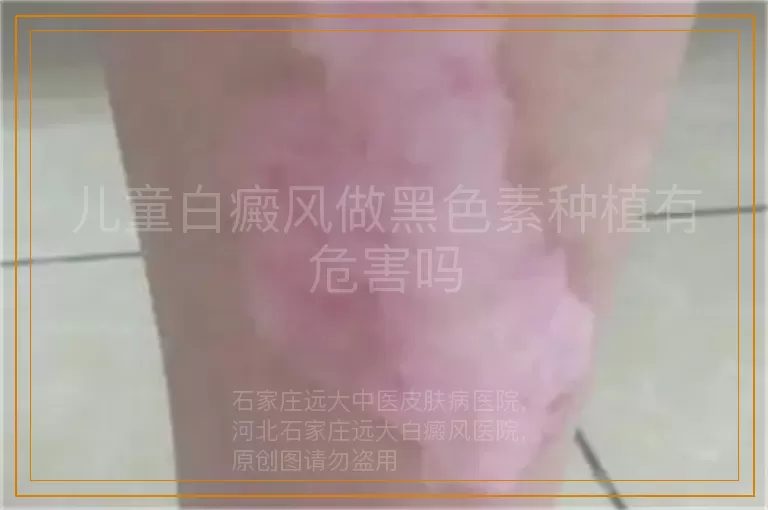儿童白癜风做黑色素种植有危害吗