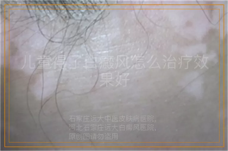 儿童得了白癜风怎么治疗效果好