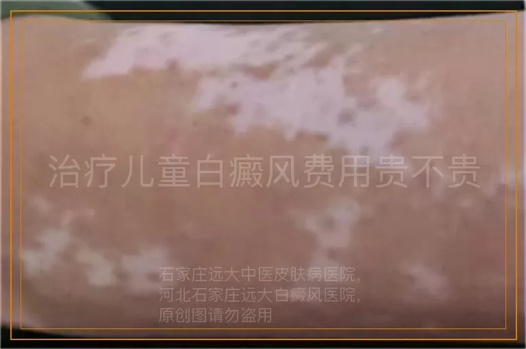 治疗儿童白癜风费用贵不贵