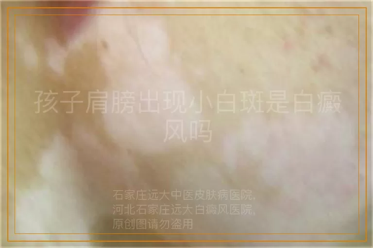 孩子肩膀出现小白斑是白癜风吗