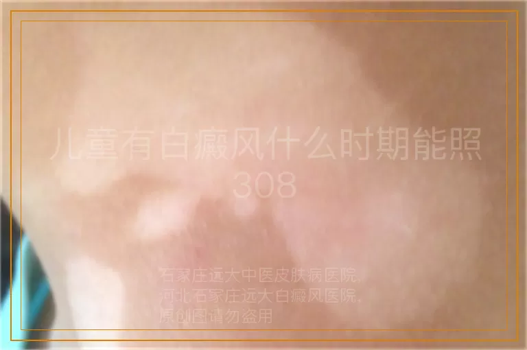 儿童有白癜风什么时期能照308