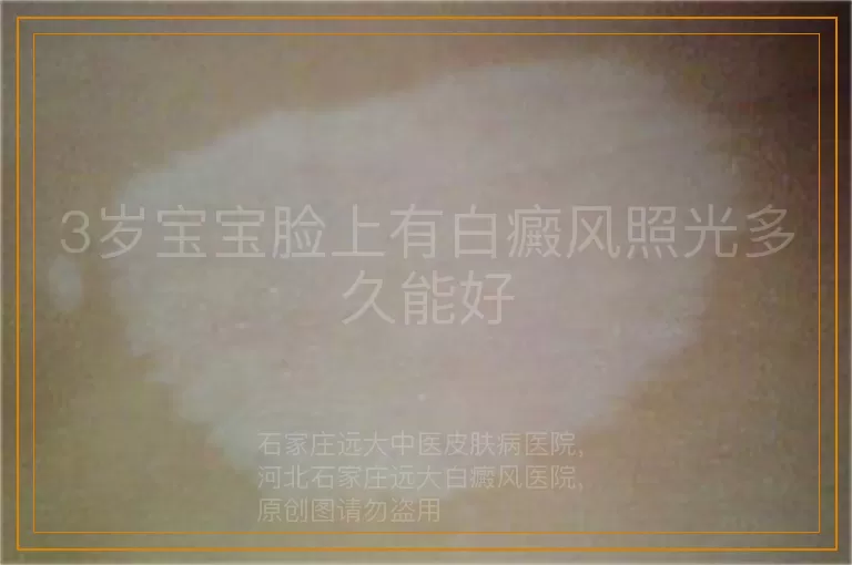 3岁宝宝脸上有白癜风照光多久能好