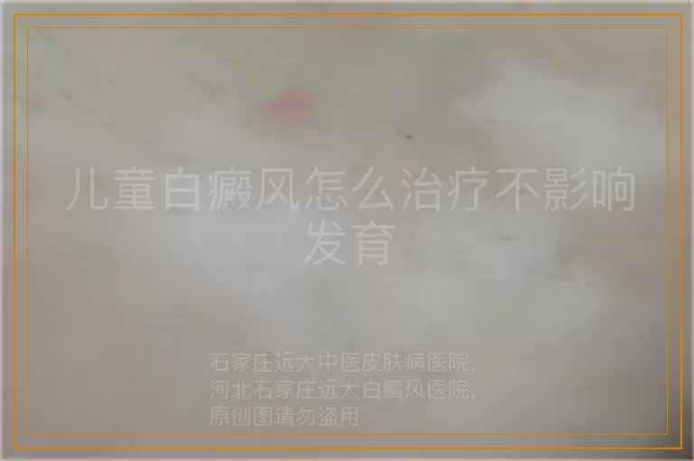 儿童白癜风怎么治疗不影响发育