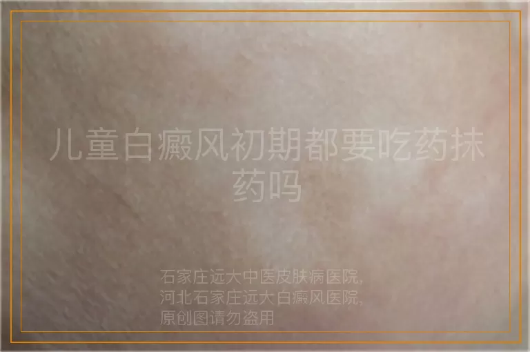 儿童白癜风初期都要吃药抹药吗