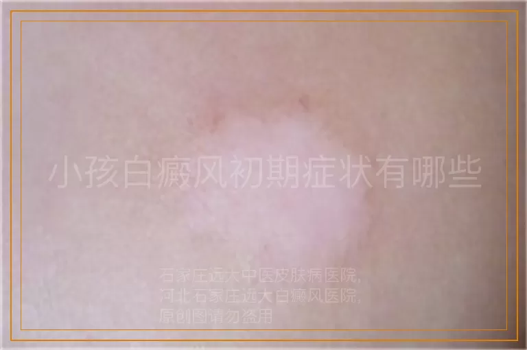 小孩白癜风初期症状有哪些