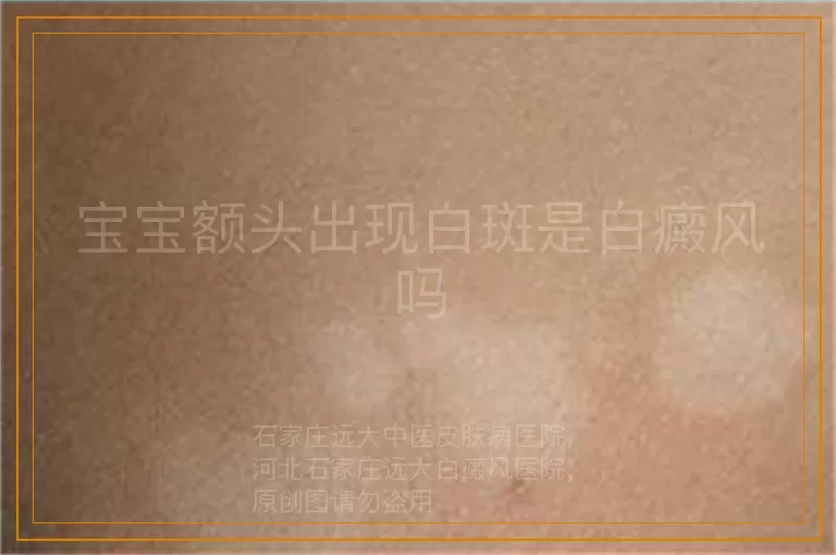 宝宝额头出现白斑是白癜风吗