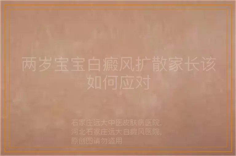 两岁宝宝白癜风扩散家长该如何应对