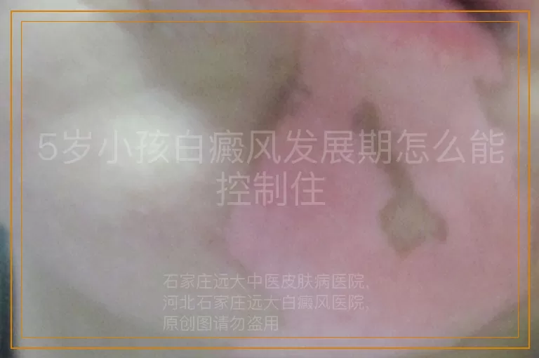 5岁小孩白癜风发展期怎么能控制住