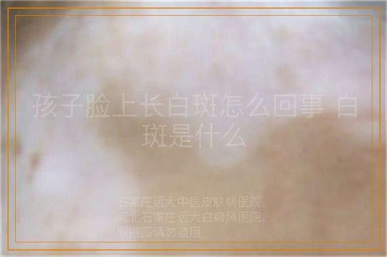 孩子脸上长白斑怎么回事 白斑是什么
