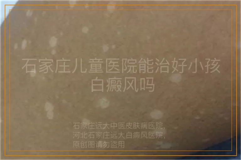 石家庄儿童医院能治好小孩白癜风吗