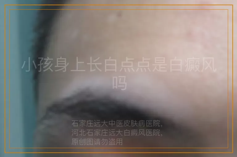 小孩身上长白点点是白癜风吗