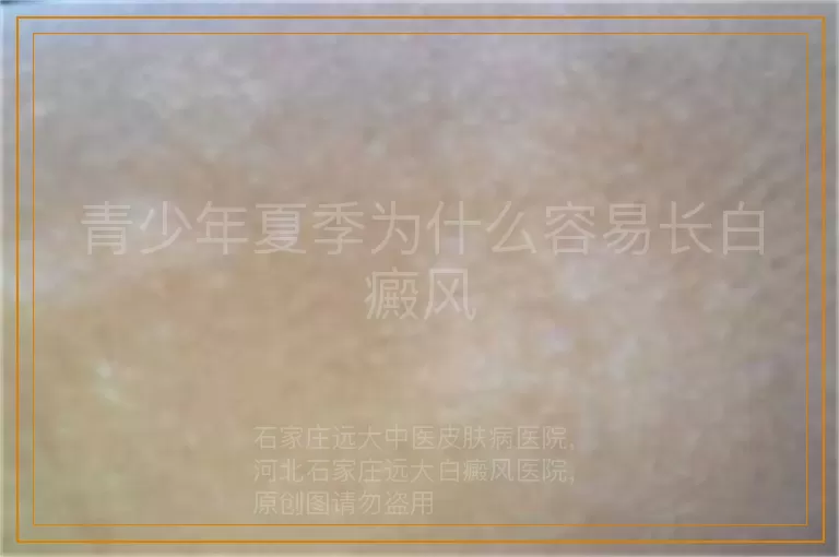 青少年夏季为什么容易长白癜风
