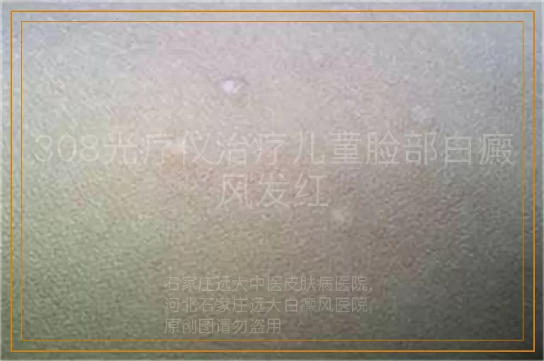 308光疗仪治疗儿童脸部白癜风发红