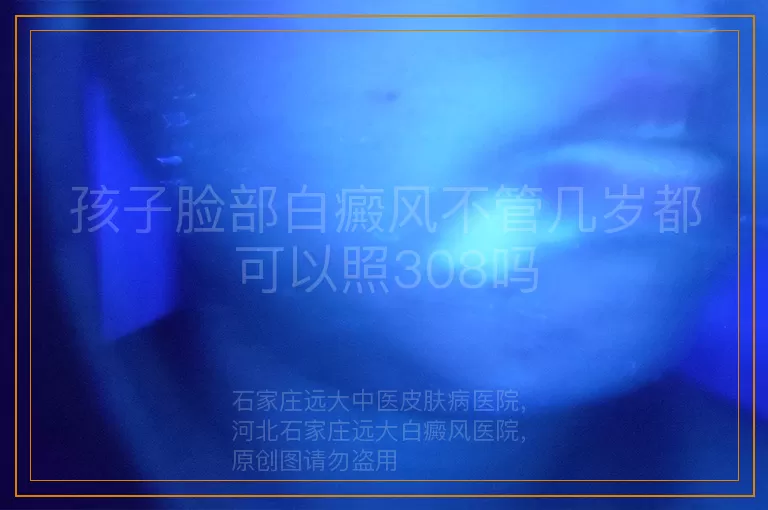 孩子脸部白癜风不管几岁都可以照308吗