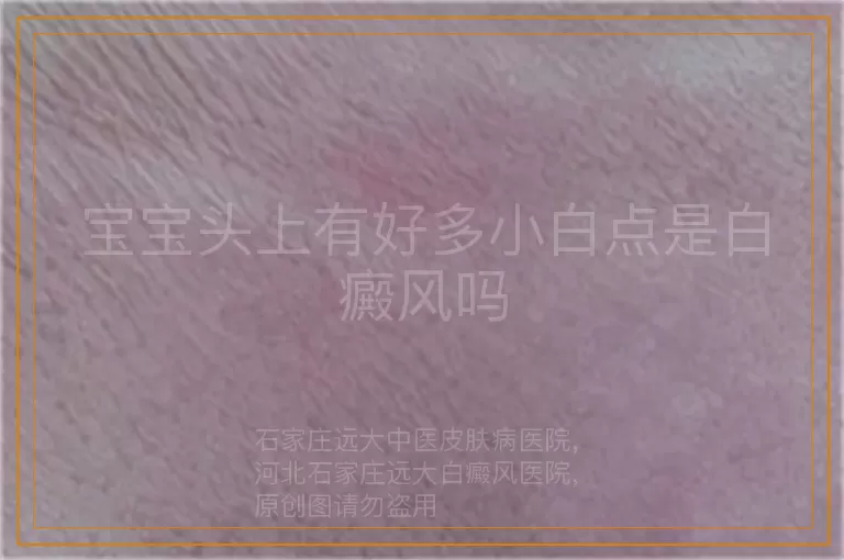 宝宝头上有好多小白点是白癜风吗