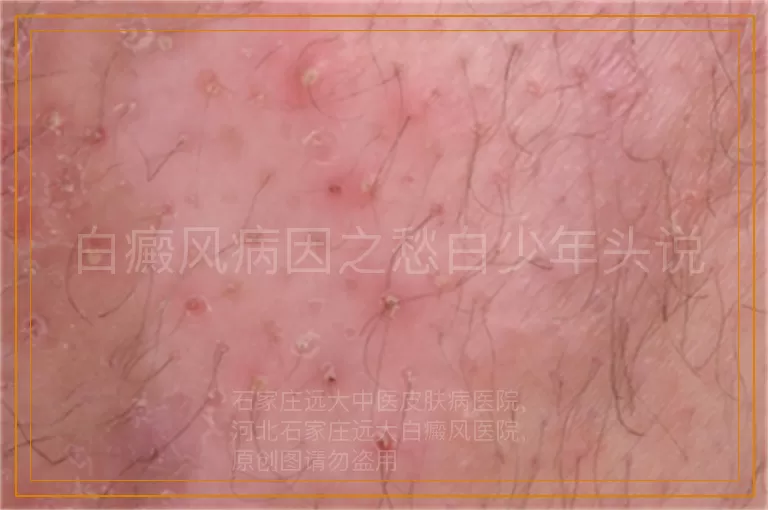白癜风病因之愁白少年头说