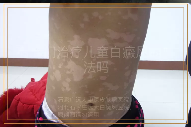有专门治疗儿童白癜风的方法吗