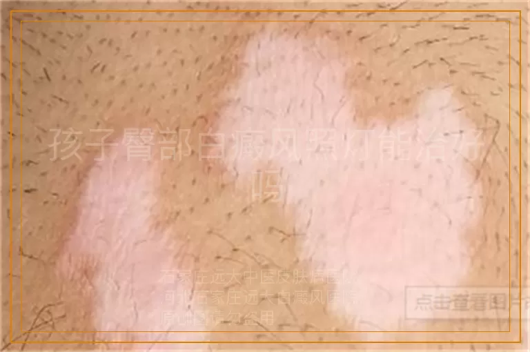 孩子臀部白癜风照灯能治好吗
