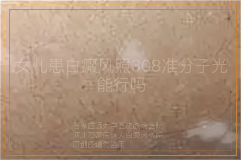 女儿患白癜风照308准分子光能行吗