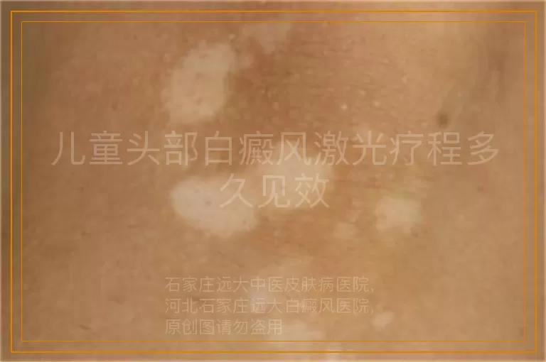儿童头部白癜风激光疗程多久见效