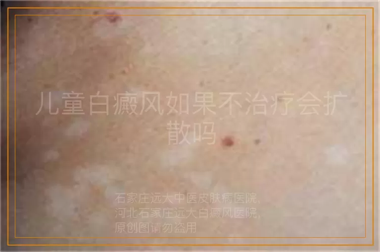 儿童白癜风如果不治疗会扩散吗
