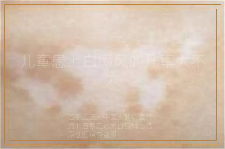 儿童患上白癜风的几率大不大