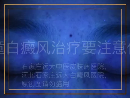 儿童白癜风治疗要注意什么