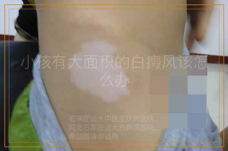 小孩有大面积的白癜风该怎么办