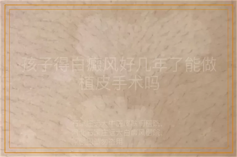 孩子得白癜风好几年了能做植皮手术吗
