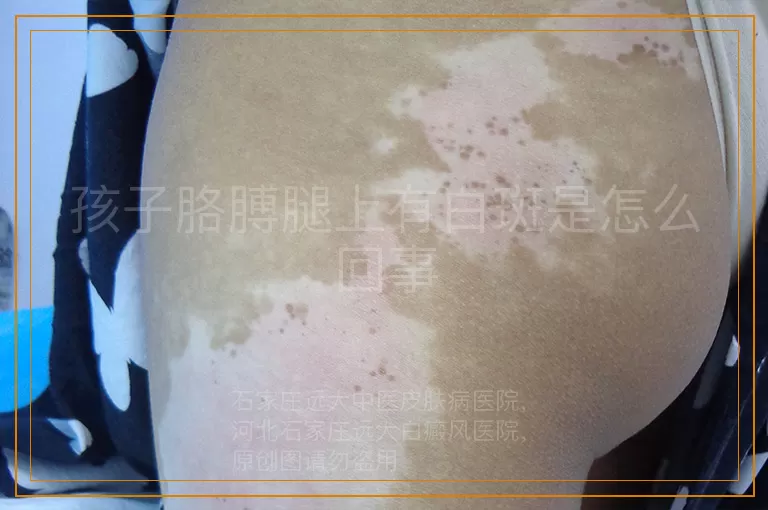 孩子胳膊腿上有白斑是怎么回事