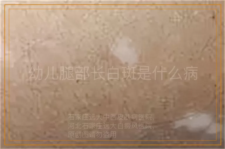 幼儿腿部长白斑是什么病