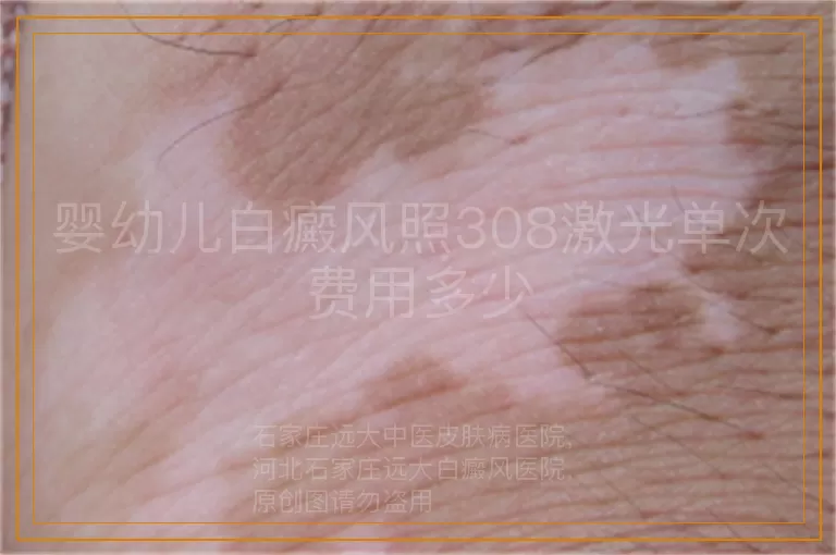 婴幼儿白癜风照308激光单次费用多少