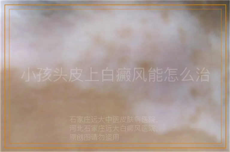 小孩头皮上白癜风能怎么治