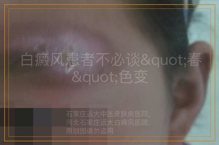 白癜风患者不必谈"春"色变