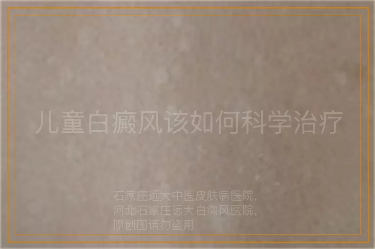 儿童白癜风该如何科学治疗