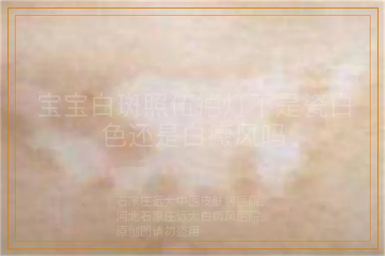 宝宝白斑照伍德灯不是瓷白色还是白癜风吗