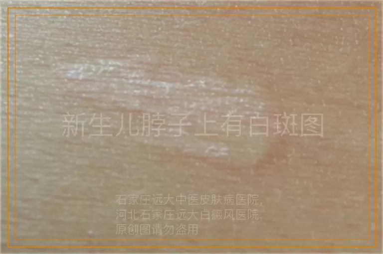 新生儿脖子上有白斑图