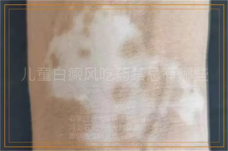 儿童白癜风吃药禁忌有哪些