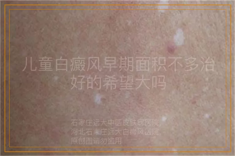 儿童白癜风早期面积不多治好的希望大吗