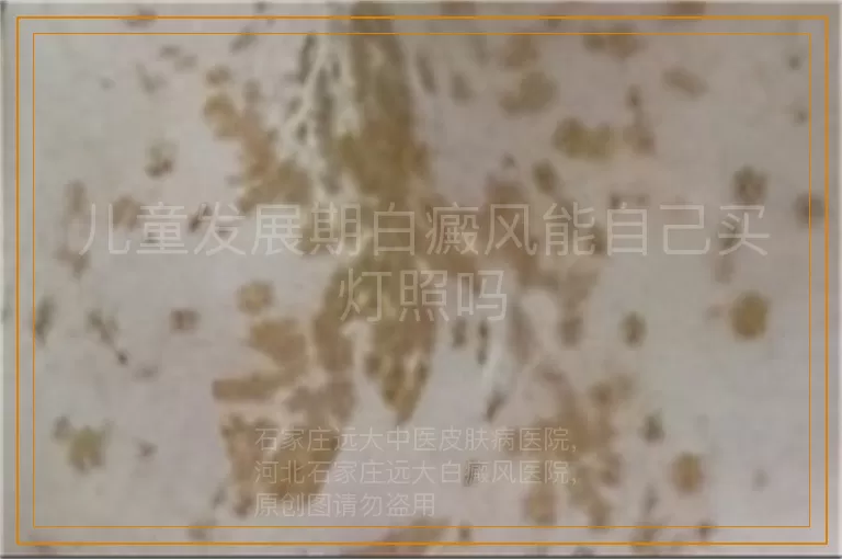 儿童发展期白癜风能自己买灯照吗