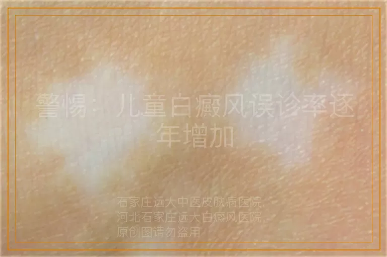 警惕：儿童白癜风误诊率逐年增加