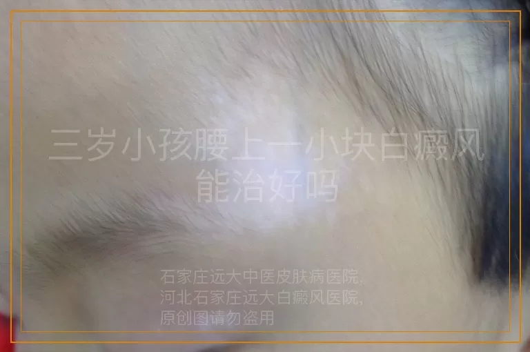 三岁小孩腰上一小块白癜风能治好吗