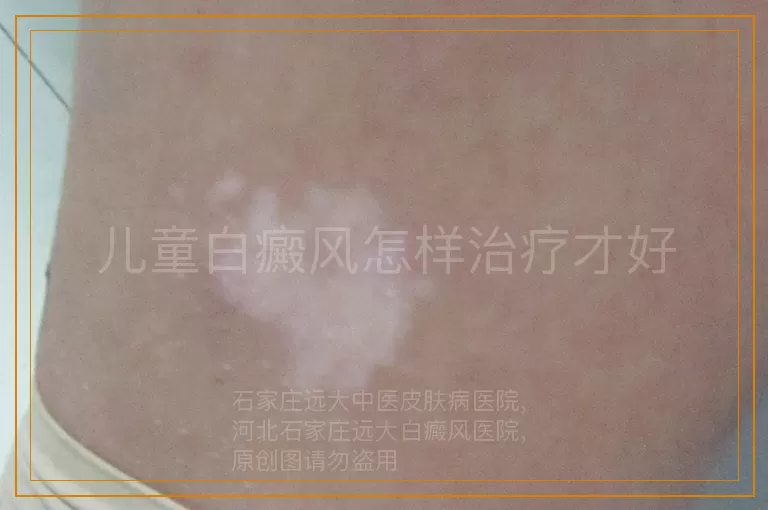 儿童白癜风怎样治疗才好