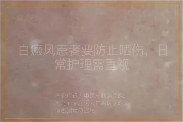 白癜风患者要防止晒伤，日常护理需重视