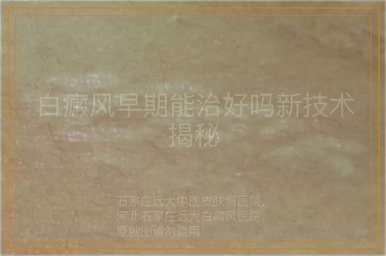 白癜风早期能治好吗新技术揭秘