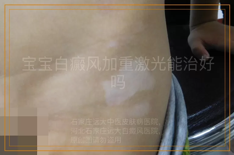 宝宝白癜风加重激光能治好吗