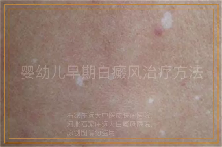 婴幼儿早期白癜风治疗方法