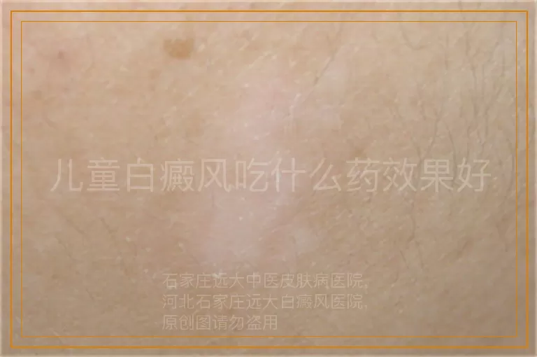 儿童白癜风吃什么药效果好